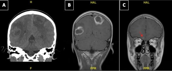 Cerebral Abscess Figure 1.jpg