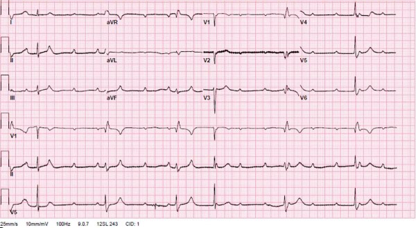 Heart Block Figure 1.jpg