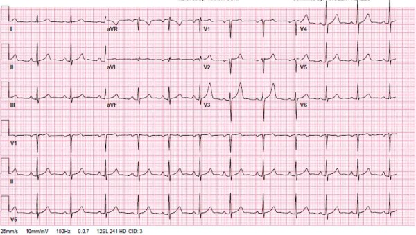 Heart Block Figure 2.jpg