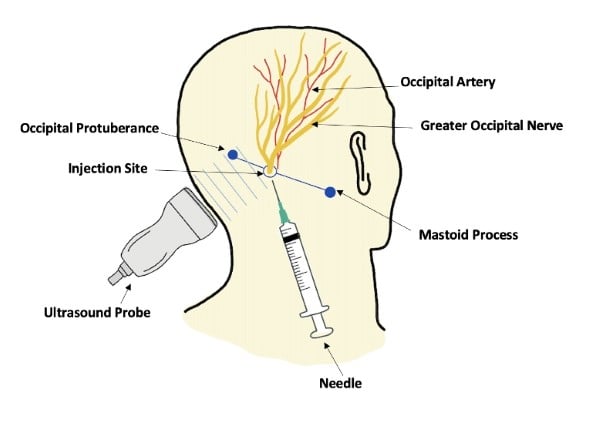 Migraines Figure 1.jpg