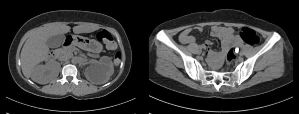 Ureteric Figure 2.jpeg