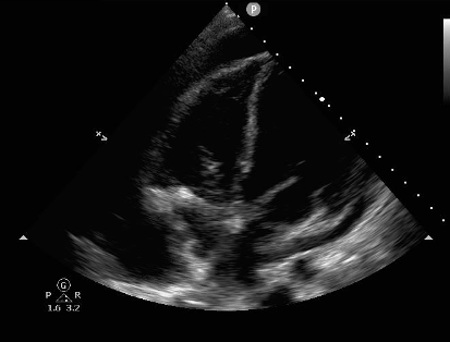 pericardial effusion ultrasound