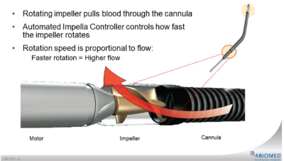 Impella - Fig 1.png