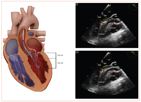 Impella - Fig 2.png