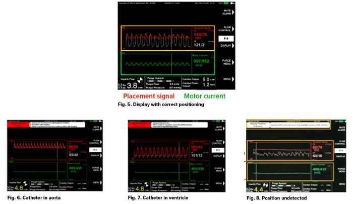 Impella - Fig 5-8 - positioning.jpg