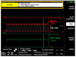 Impella - Fig 9 - suction event.png